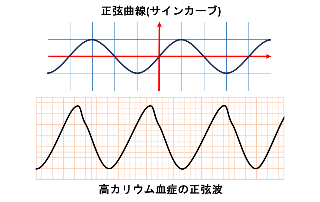 高カリウム血症(Hyperkalemia)