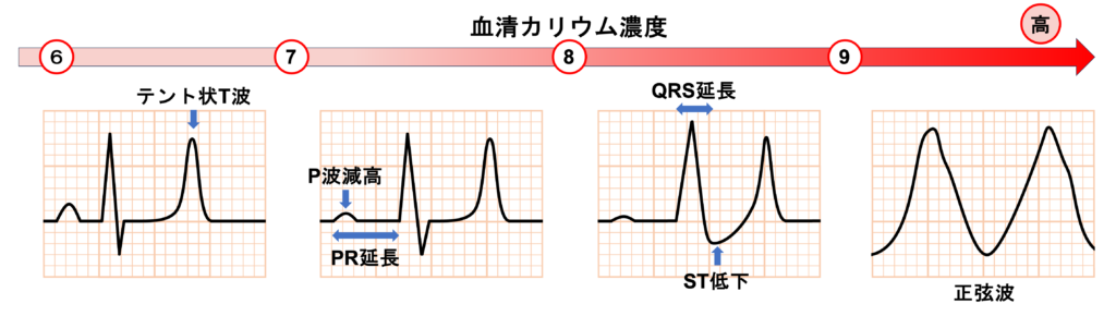 高カリウム血症(Hyperkalemia)