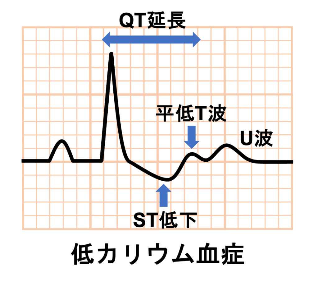 低カリウム血症(Hypokalaemia)