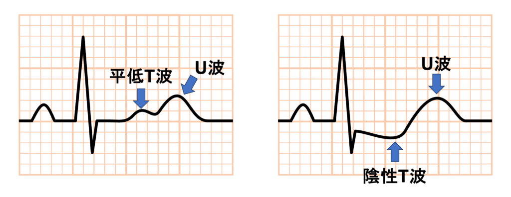 低カリウム血症(Hypokalaemia)