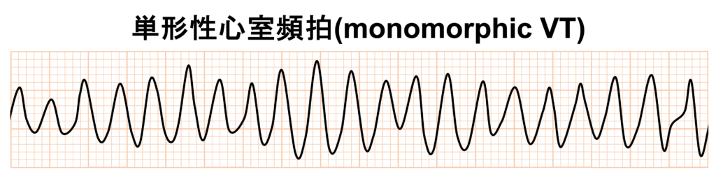 心室頻拍(Ventricular Tachycardia)