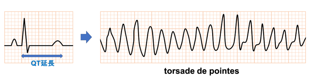 低カルシウム血症(Hypocalcemia)