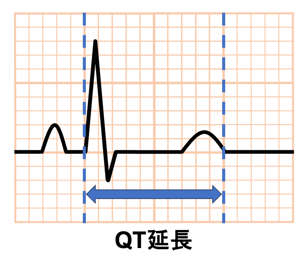 低カルシウム血症(Hypocalcemia)