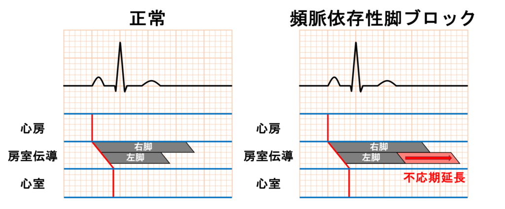 頻脈依存性脚ブロック(Tachycardia-dependent bundle branch block)