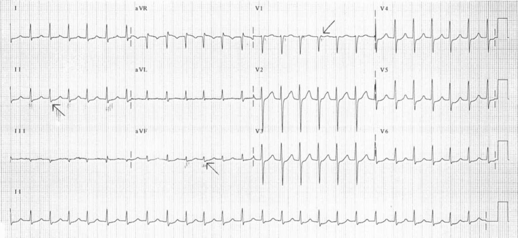 upper common pathway(上部共通伝導路)