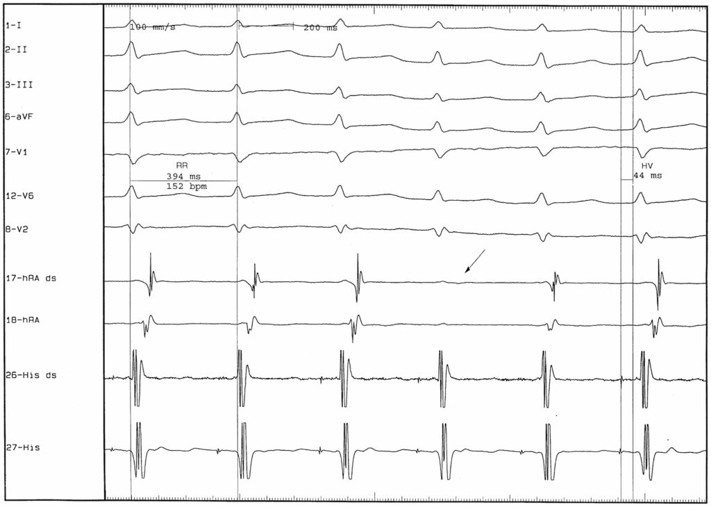 upper common pathway(上部共通伝導路)