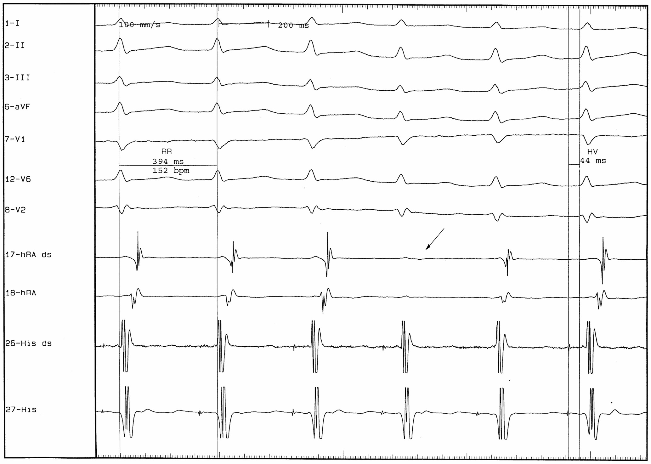 upper common pathway(上部共通伝導路)