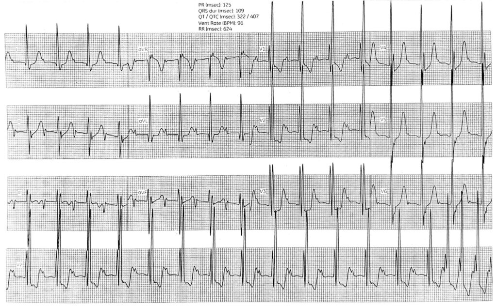lower common pathway(下部共通伝導路)