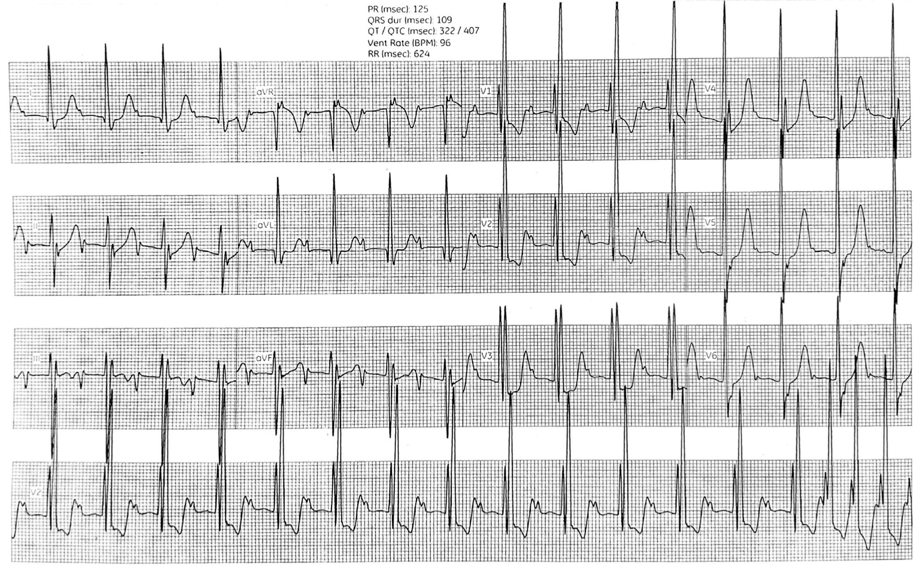 lower common pathway(下部共通伝導路)