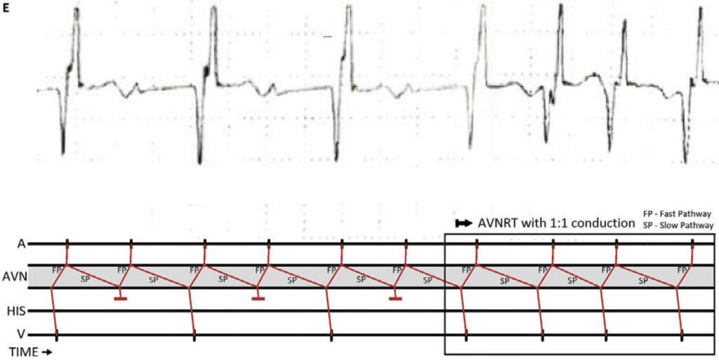 lower common pathway(下部共通伝導路)