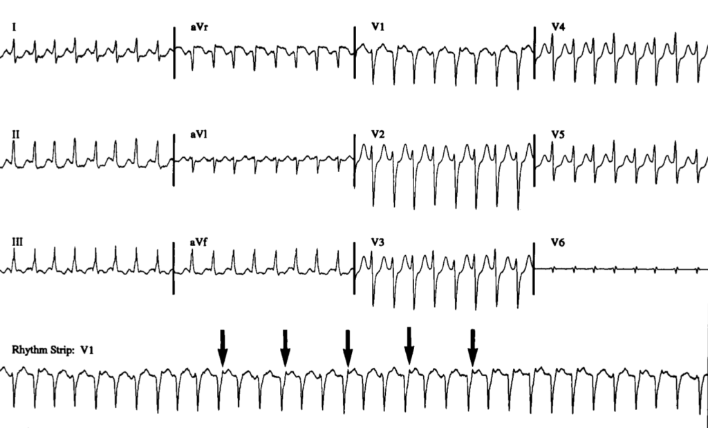 upper common pathway(上部共通伝導路)