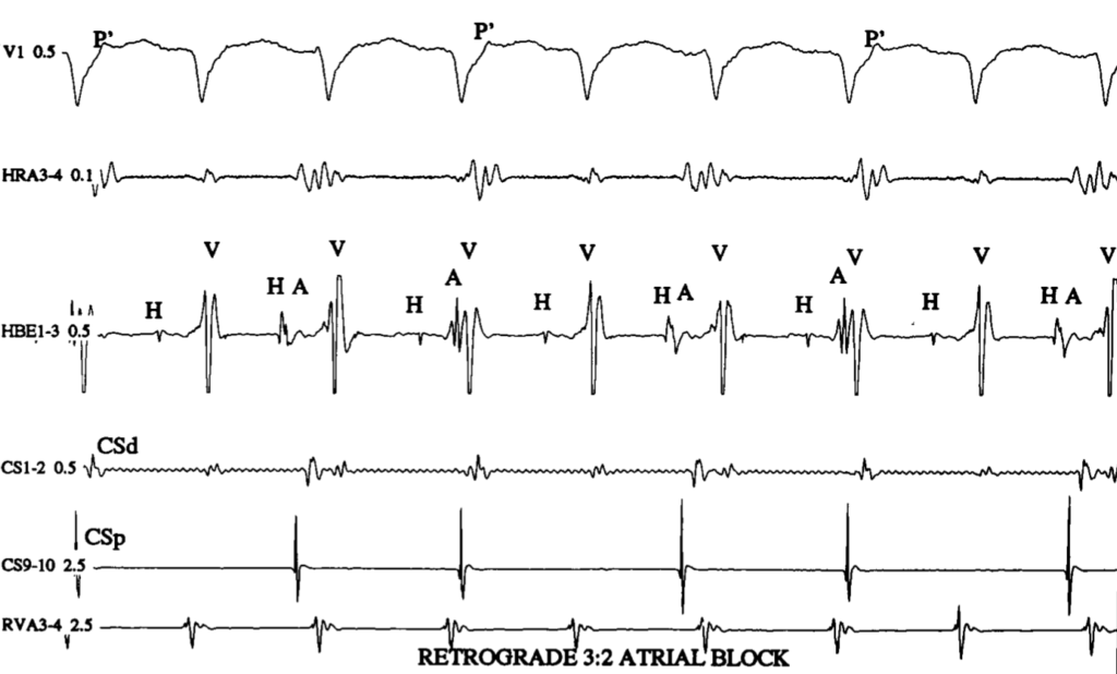 upper common pathway(上部共通伝導路)