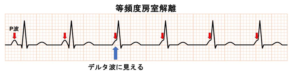 Δ波(delta wave)
房室解離では心房と心室が別々に興奮していますが、QRS波の立ち上がり部分にP波が重なるとデルタ波に見えることがあります。