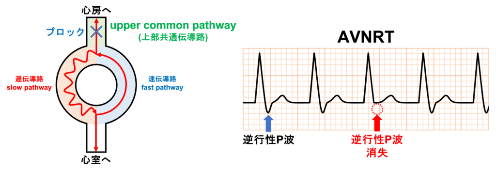 upper common pathway(上部共通伝導路)