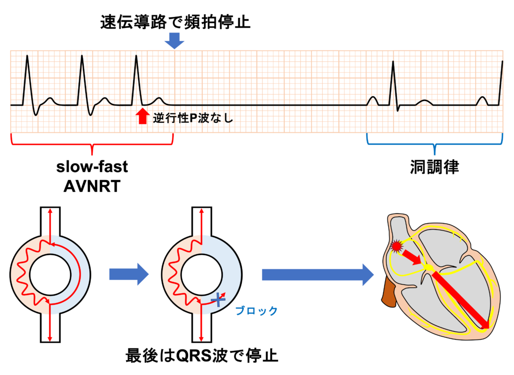 upper common pathway(上部共通伝導路)