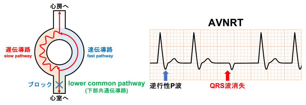 lower common pathway(下部共通伝導路)