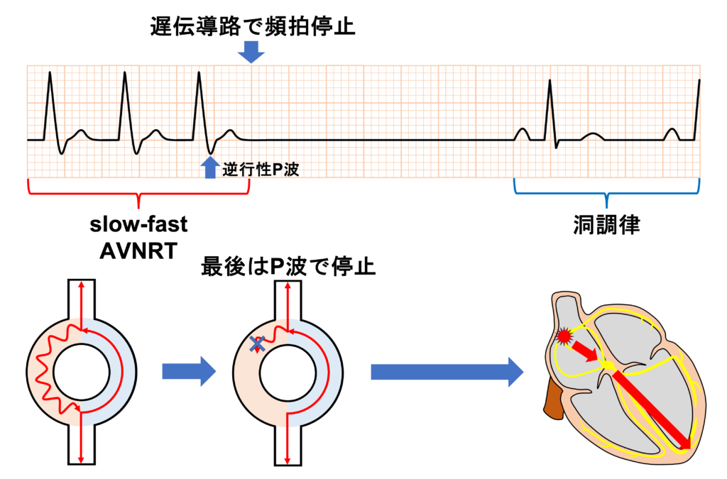 lower common pathway(下部共通伝導路)