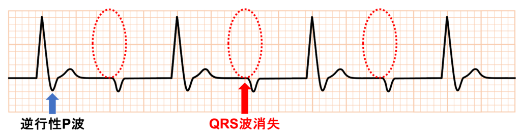 lower common pathway(下部共通伝導路)