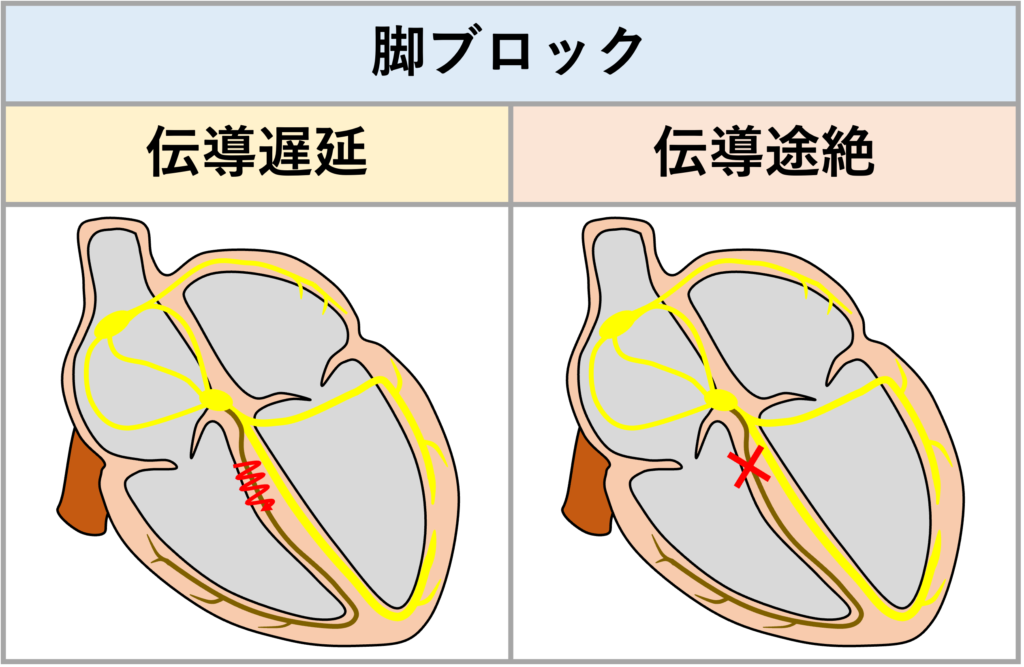 ３枝ブロック(trifascicular block)