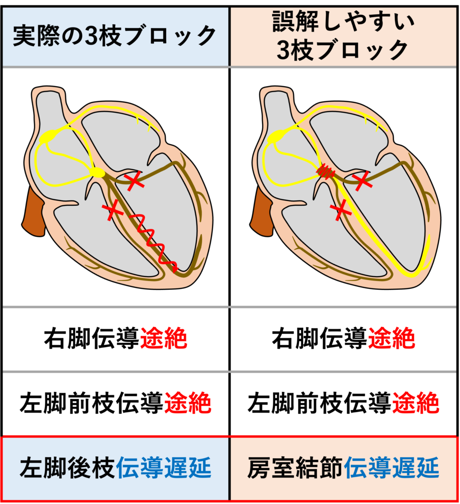 ３枝ブロック(trifascicular block)