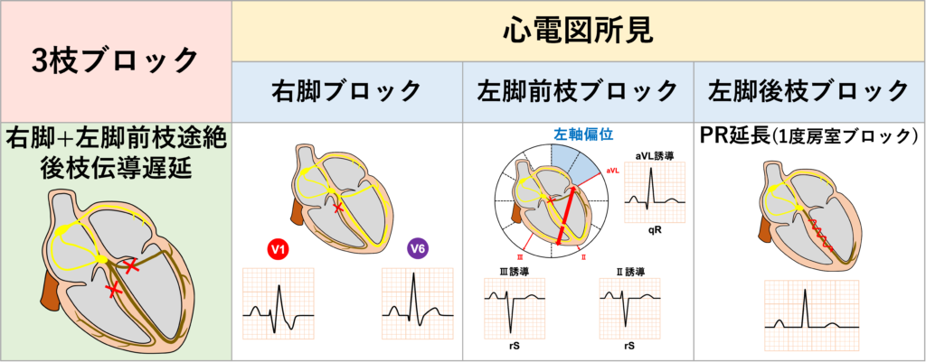 ３枝ブロック(trifascicular block)