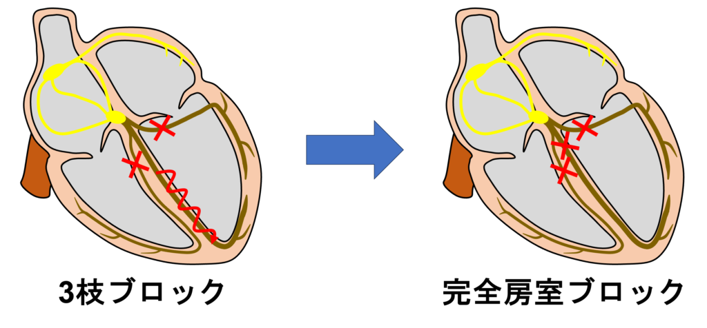 ３枝ブロック(trifascicular block)