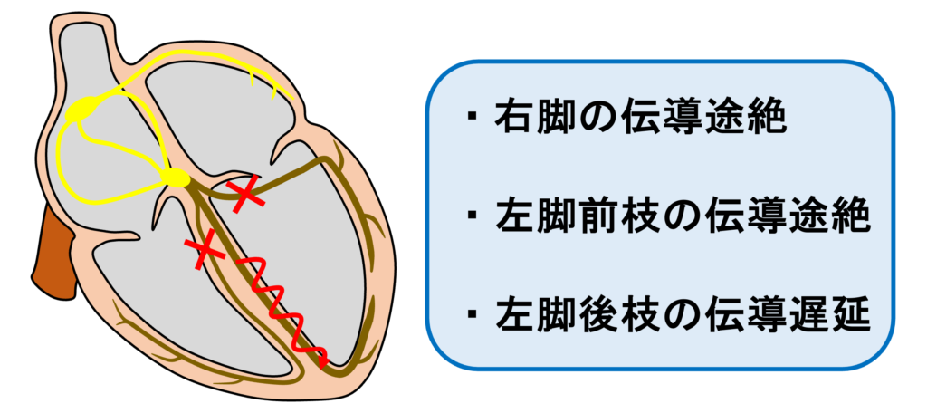 ３枝ブロック(trifascicular block)