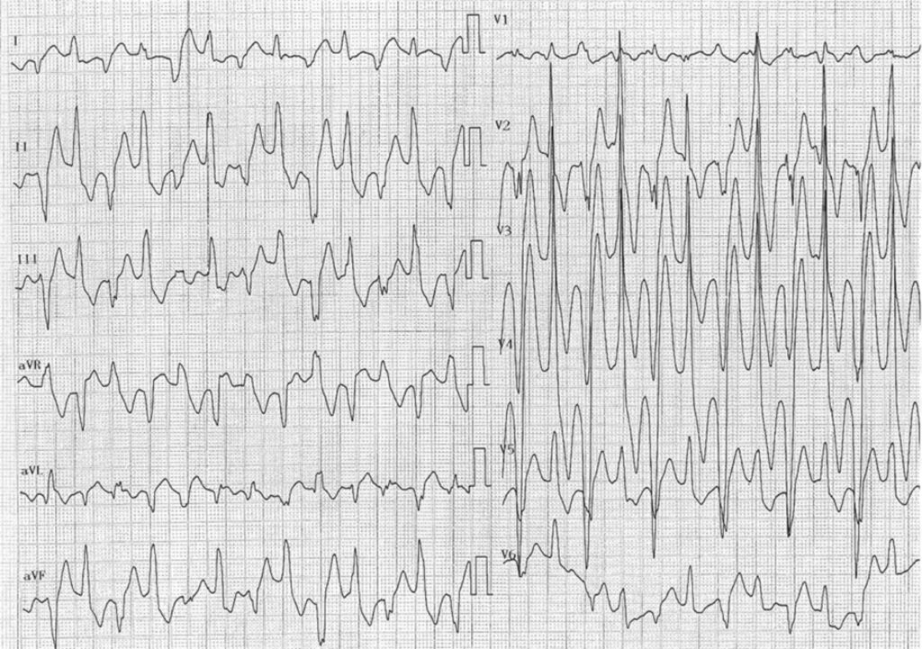 カテコラミン誘発性多形性心室頻拍(Catecholaminergic Polymorphic Ventricular Tachycardia : CPVT)