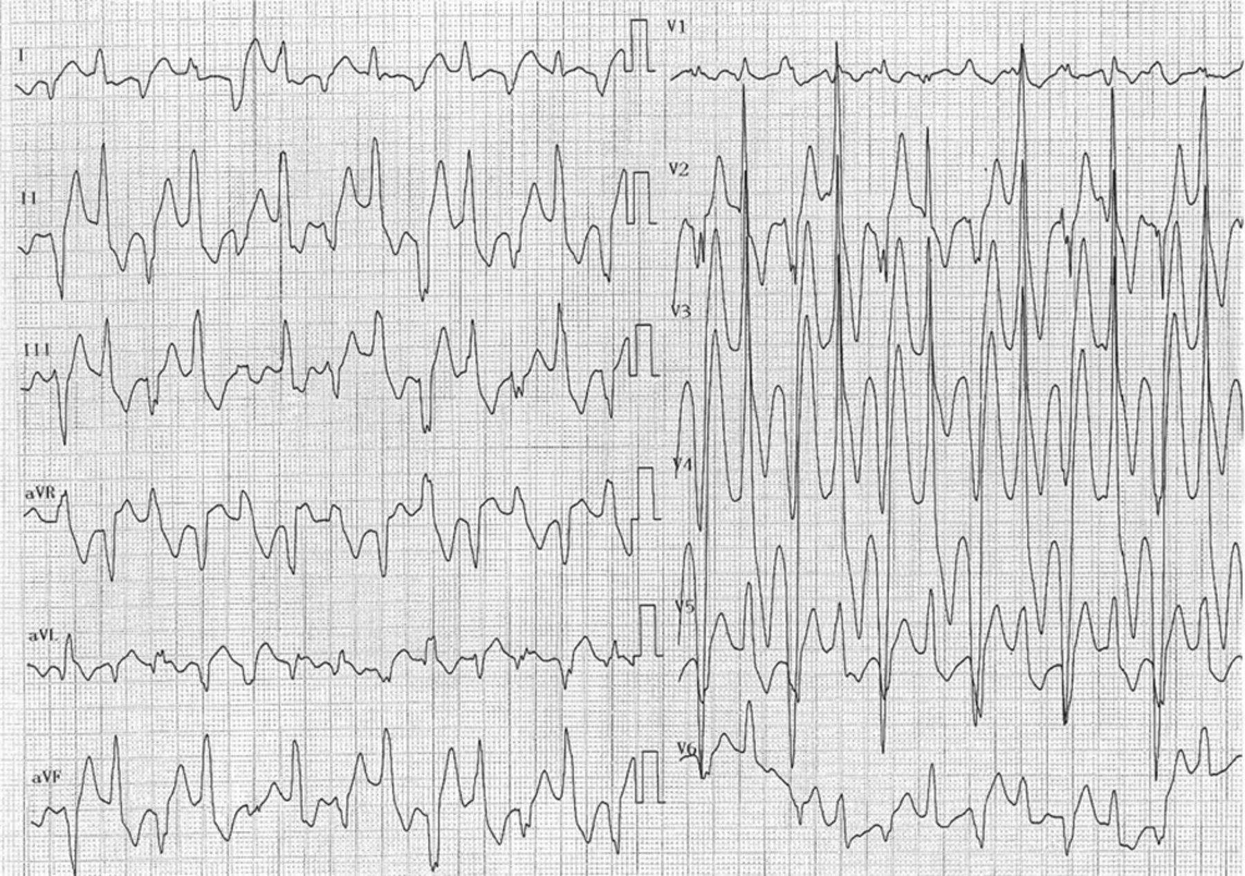 カテコラミン誘発性多形性心室頻拍(Catecholaminergic Polymorphic Ventricular Tachycardia : CPVT)