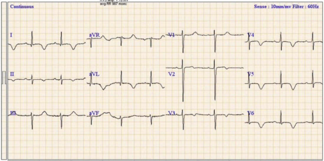 Long QT syndrome type 8：LQT8