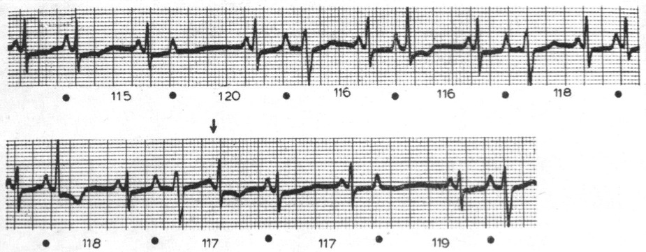 心房副収縮(atrial parasystole)