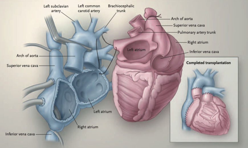 心臓移植(Heart transplantation)