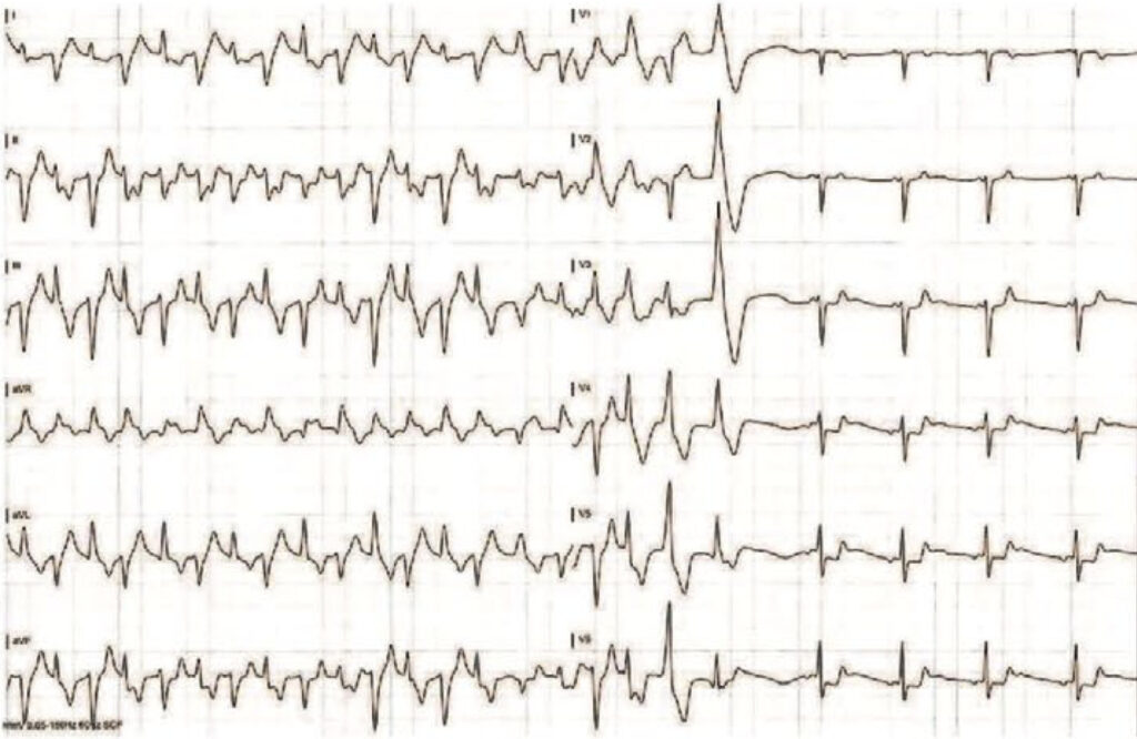 カテコラミン誘発性多形性心室頻拍(Catecholaminergic Polymorphic Ventricular Tachycardia : CPVT)