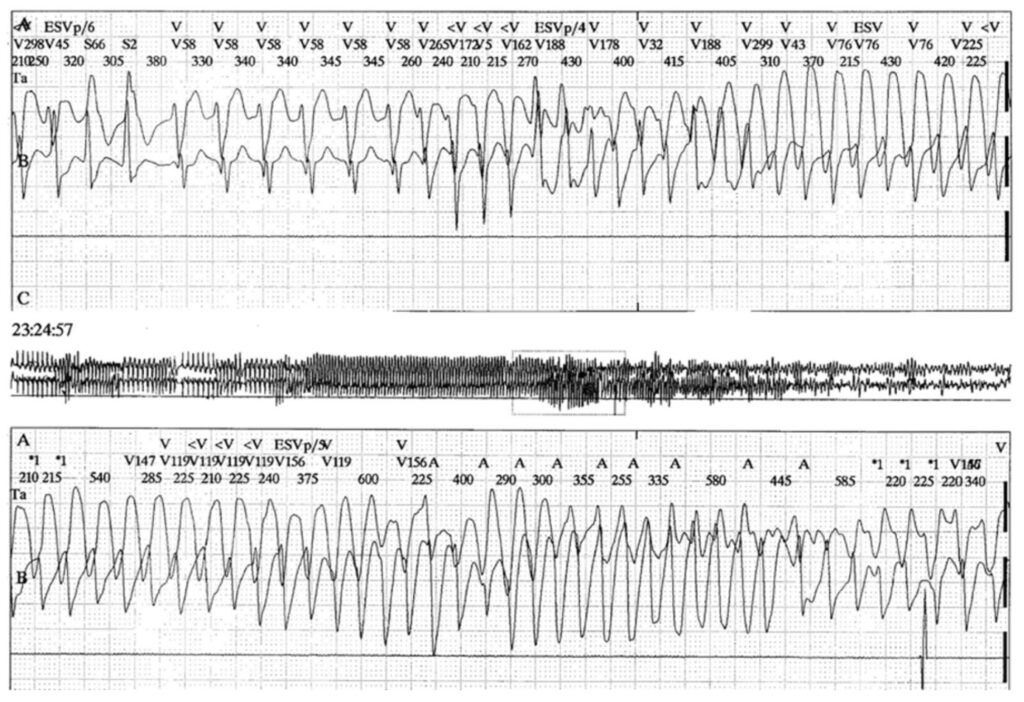 カテコラミン誘発性多形性心室頻拍(Catecholaminergic Polymorphic Ventricular Tachycardia : CPVT)