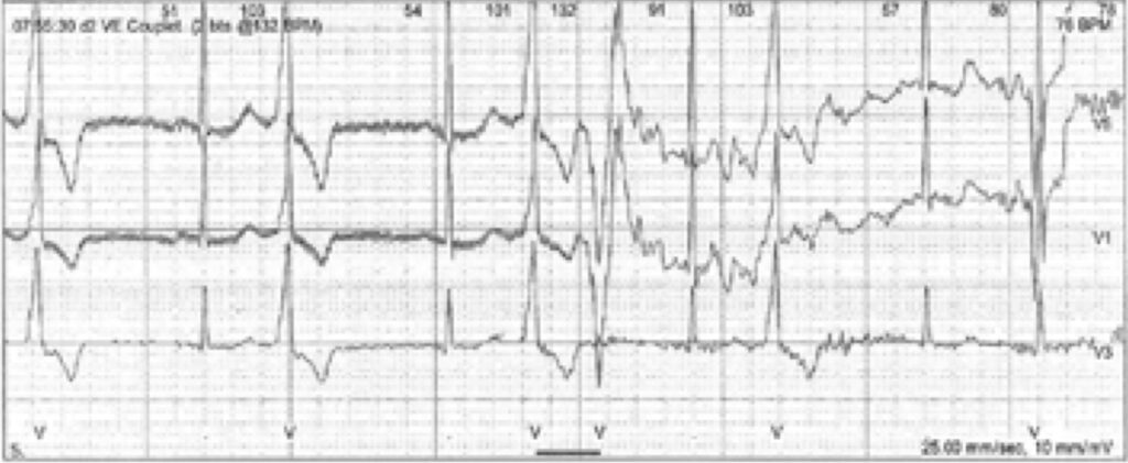 QT延長症候群7型(Long QT syndrome type 7:LQT7)