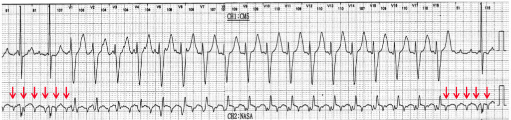 double tachycardia(二重頻拍)