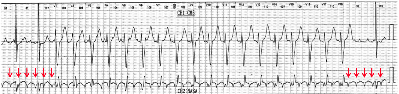 double tachycardia(二重頻拍)