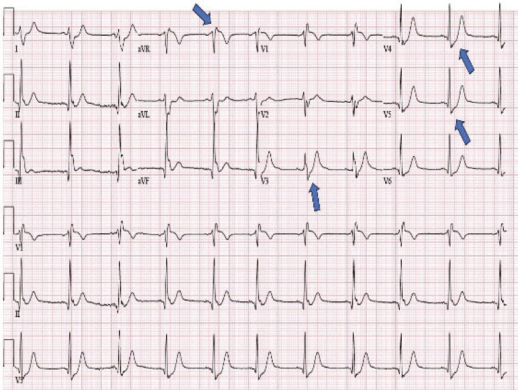 de Winter ST/T wave complex
