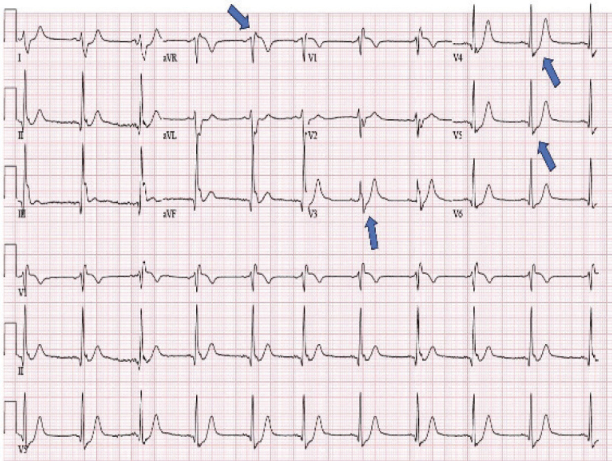 de Winter ST/T wave complex