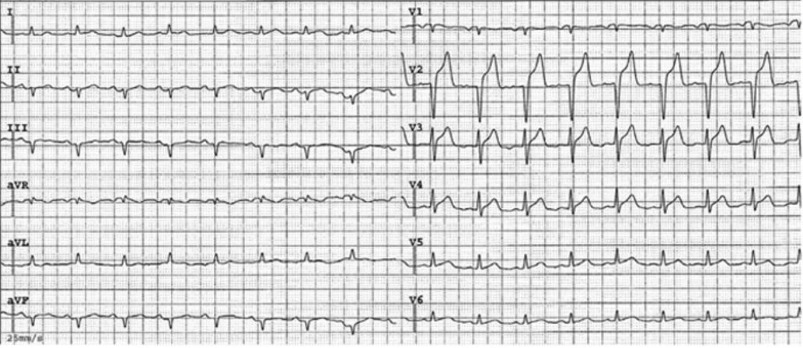 たこつぼ心筋症(Takotsubo Cardiomyopathy)