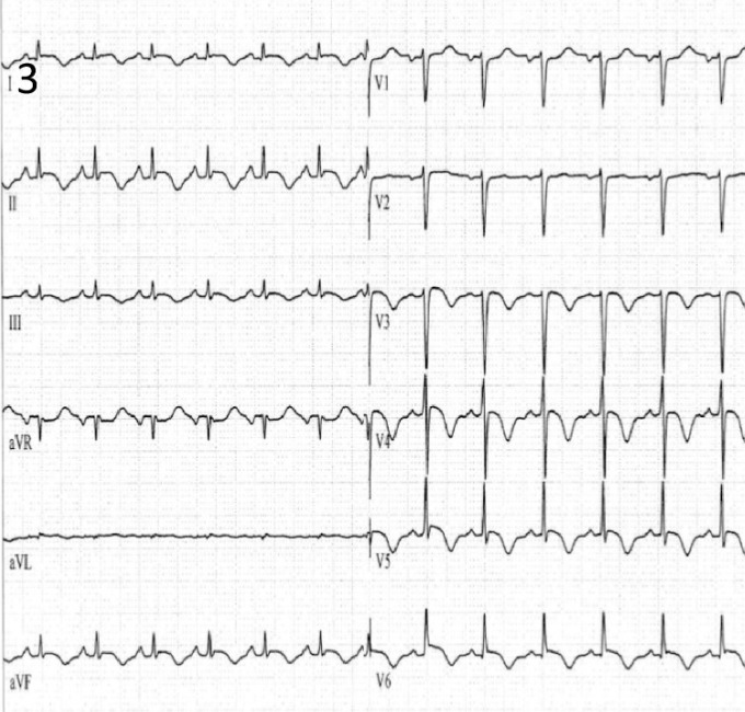 たこつぼ心筋症(Takotsubo Cardiomyopathy)