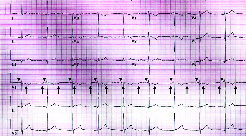 心臓移植(Heart transplantation)