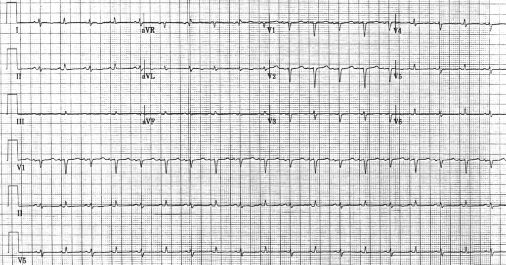 心タンポナーデ(cardiac tamponade)