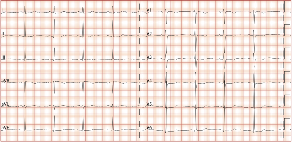 QT延長症候群7型(Long QT syndrome type 7:LQT7)