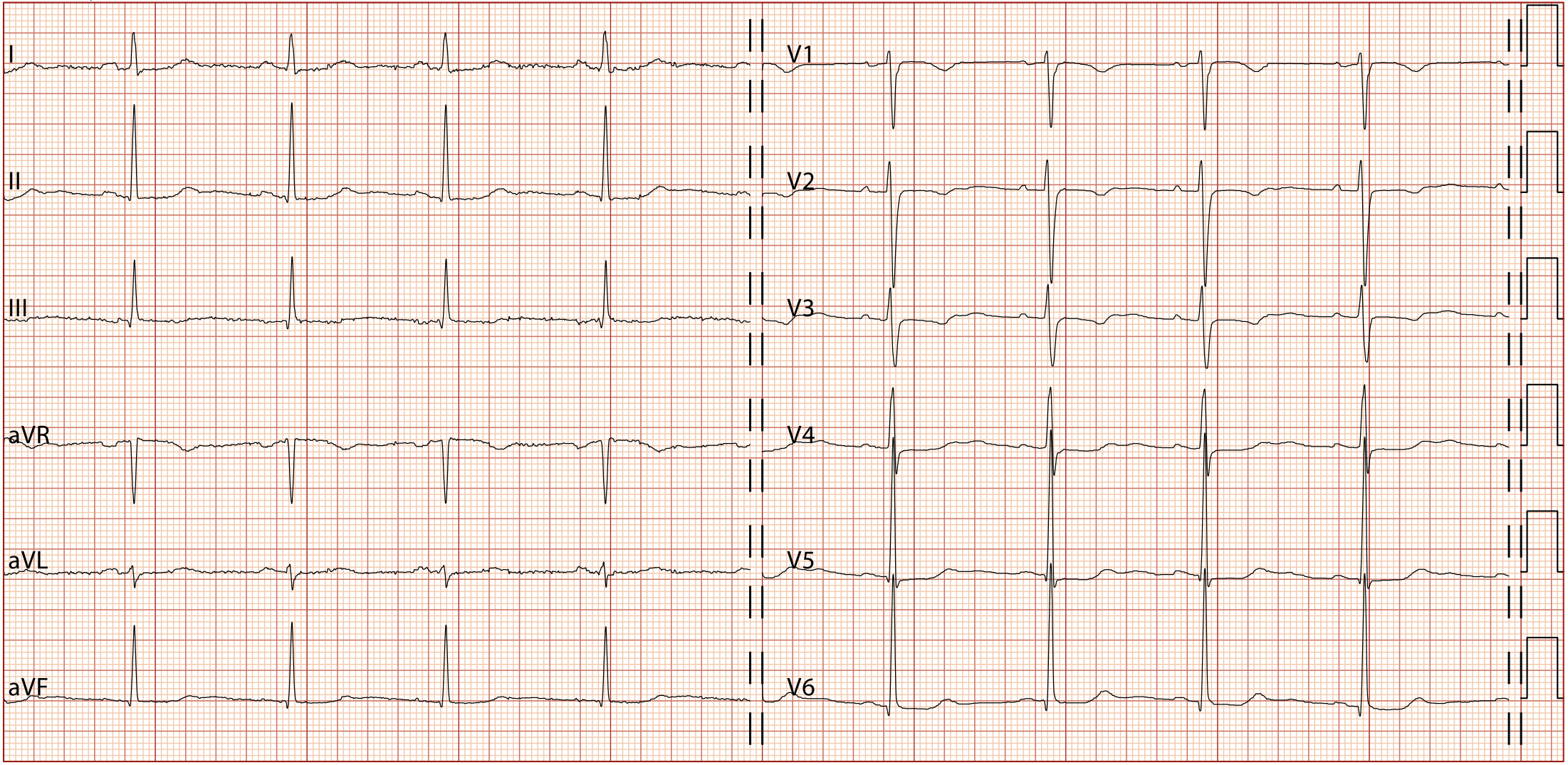 QT延長症候群7型(Long QT syndrome type 7：LQT7)