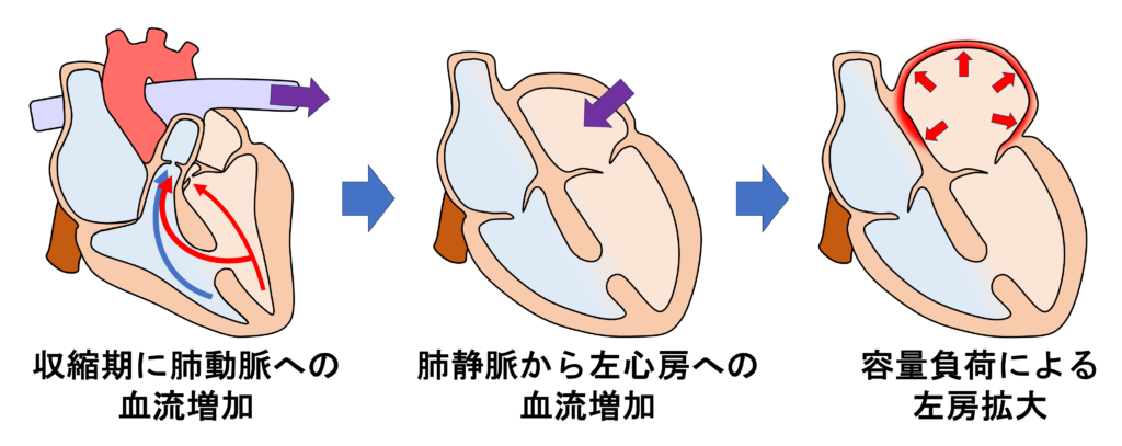 心室中隔欠損症(ventricular septal defect : VSD)