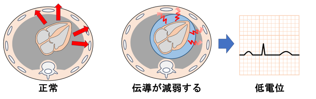 心タンポナーデ(cardiac tamponade)
