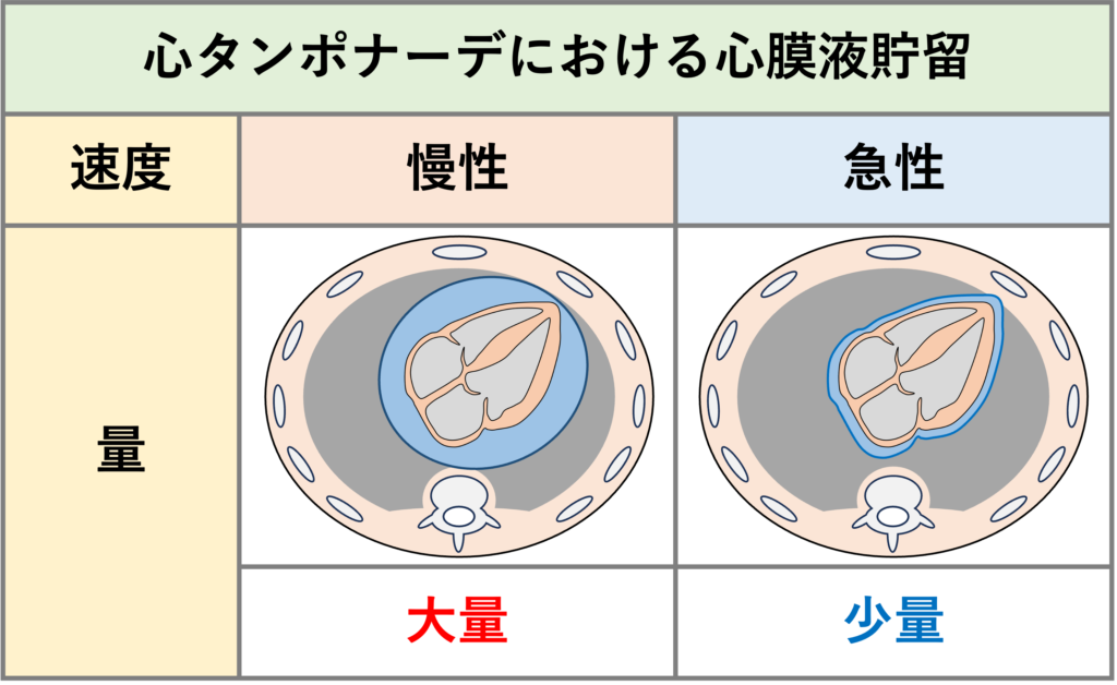 心タンポナーデ(cardiac tamponade)
