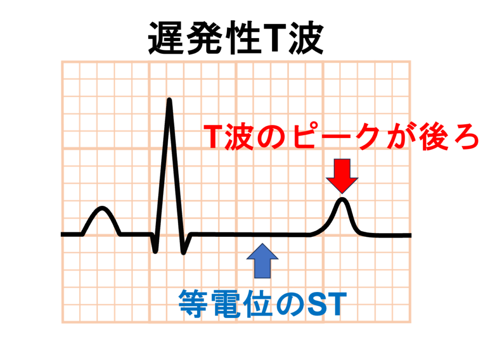 QT延長症候群8型(Long QT syndrome type 8:LQT8)
