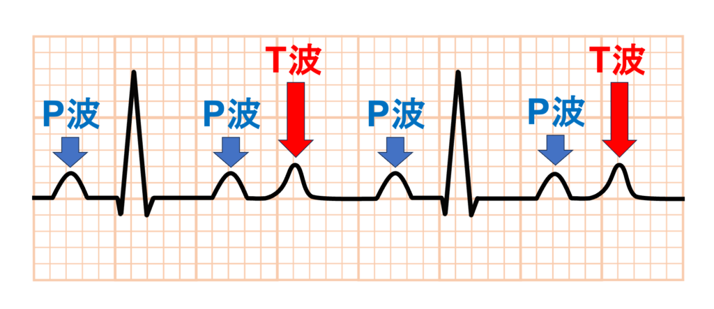 QT延長症候群8型(Long QT syndrome type 8:LQT8)
「偽性2:1房室ブロック(Pseudo 2:1AVB)」